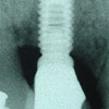 Foto implante unitrio anterior coroa metalocermica