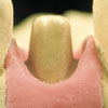 Escaneamento do preparo dentrio